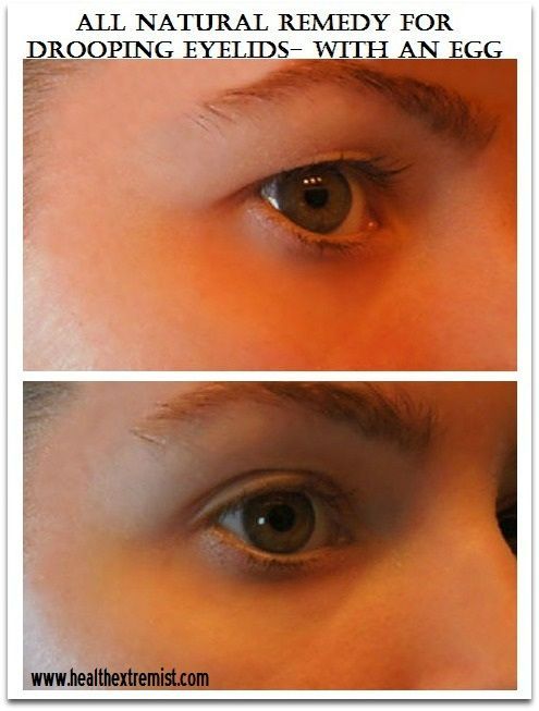 Natural remedy for drooping eyelids