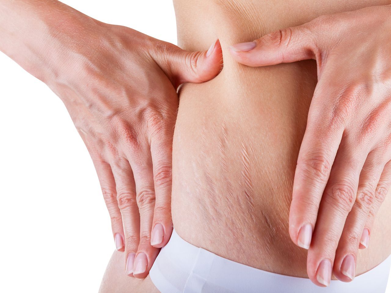 Top 10 Ways to Get Rid of Stretch Marks Fast
