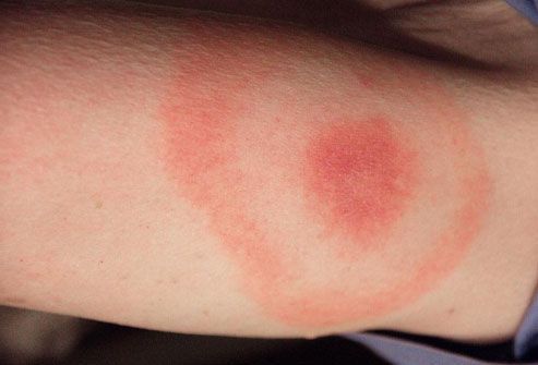 Gross, but informative – which insect makes which bite mark and how to treat bit