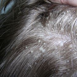 Causes of Dandruff  Irregular Hair brushing  Yeast  Dry skin  Seborrheic dermati