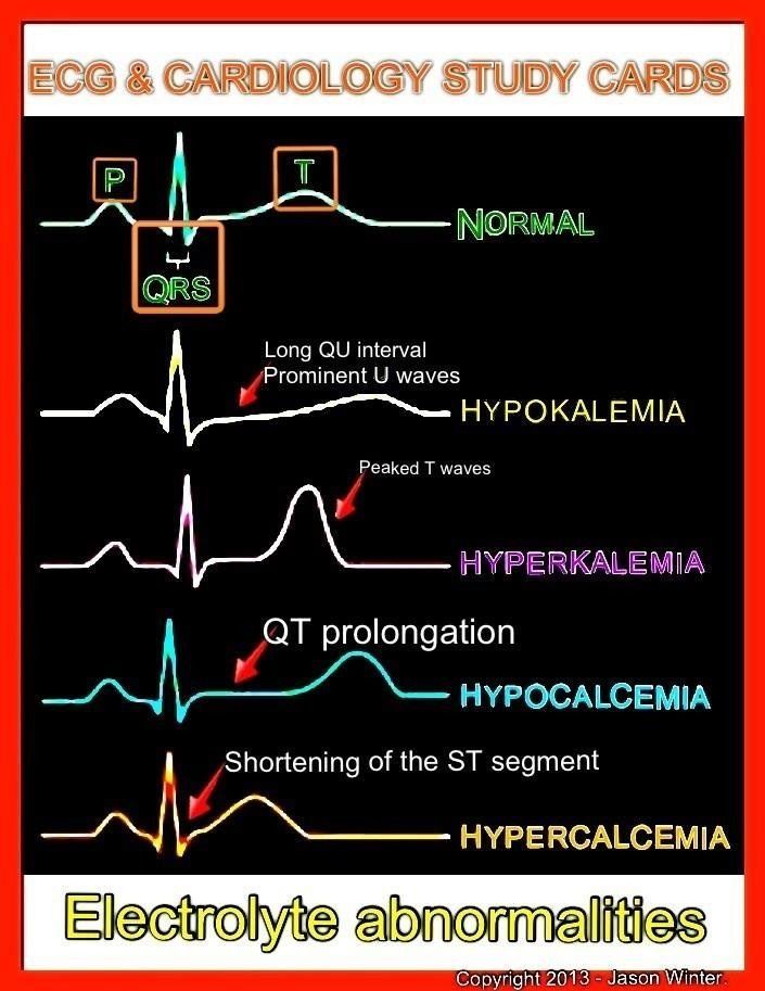Electrolytes and EKG *Keep Calm* .Nurse On…. and know how hypocalcaemia presen