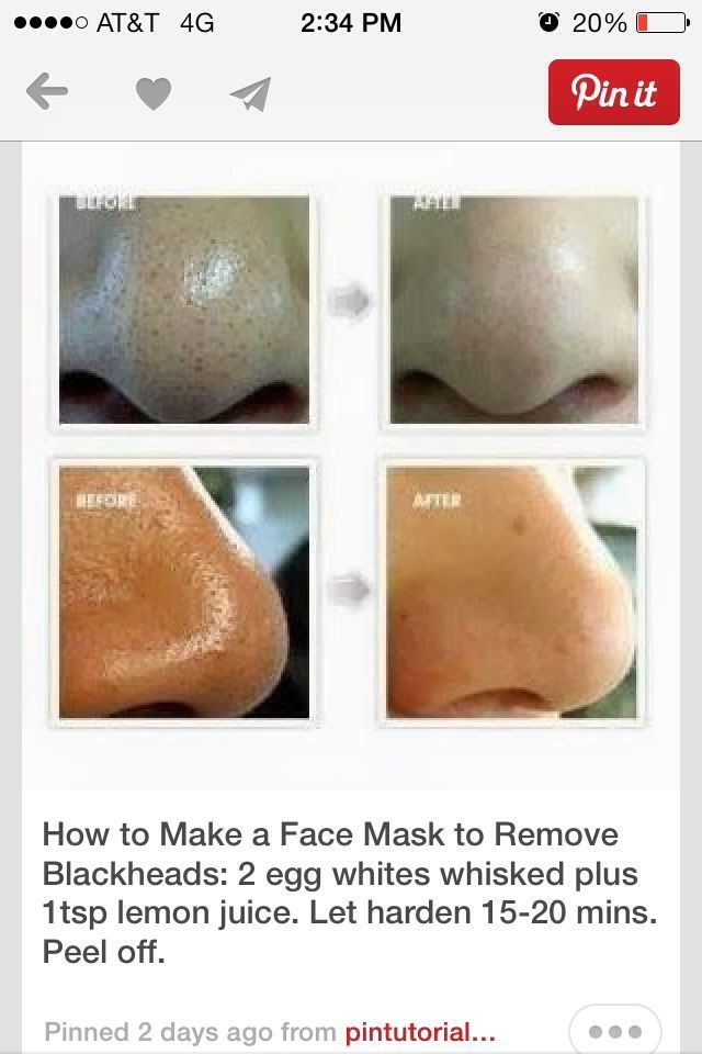 This Face Mask Can Remove Black Heads