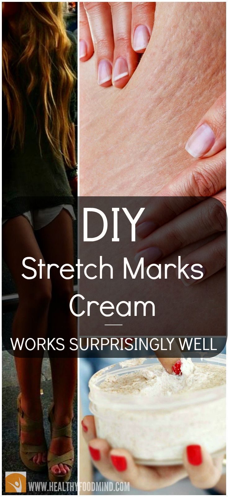Here is a a recipe for a homemade stretch mark cream that successfully fights the stretch marks as well as cellulite.