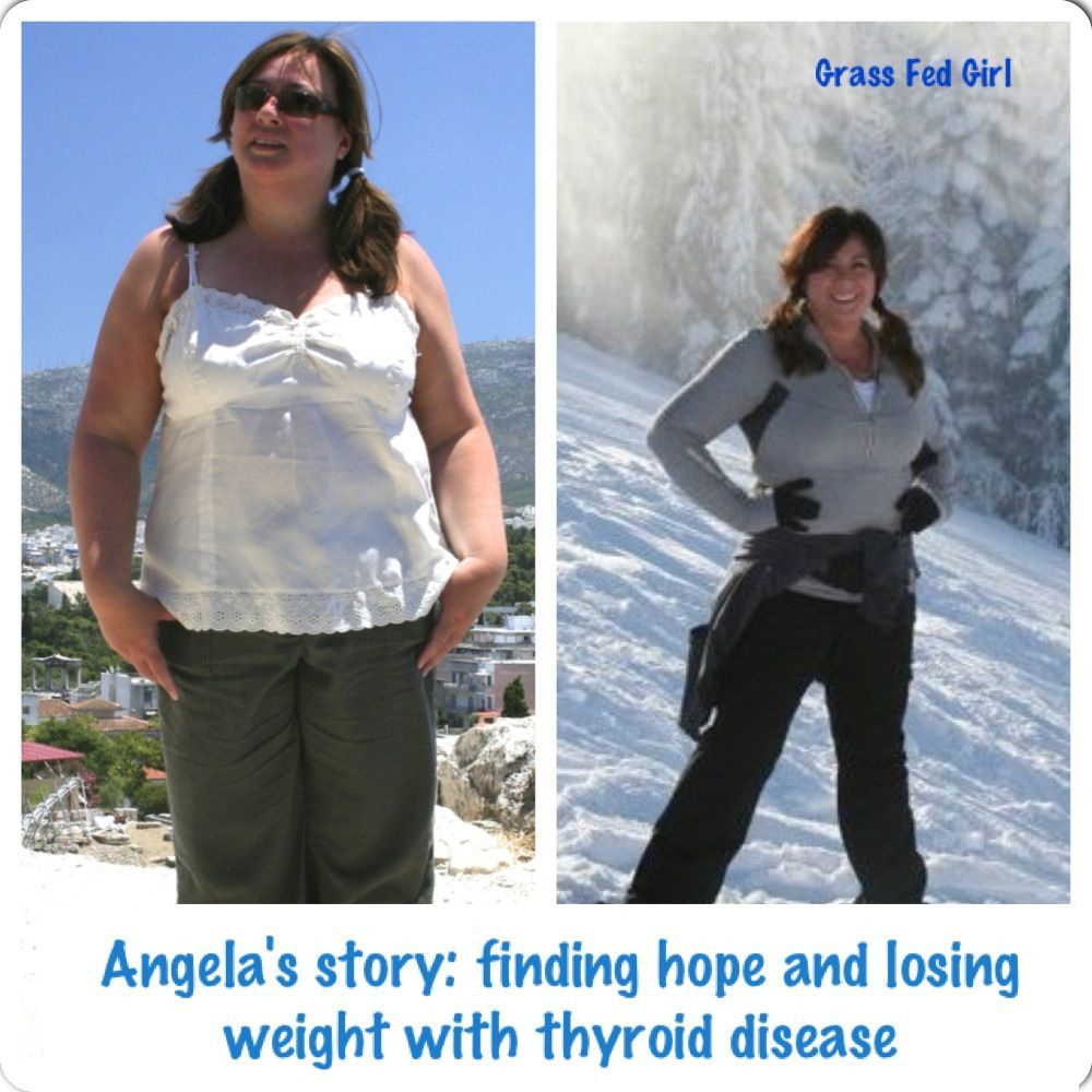 Angelas Story of Finding Hope with Hashimotos: Her tale of thyroid woes and weight loss