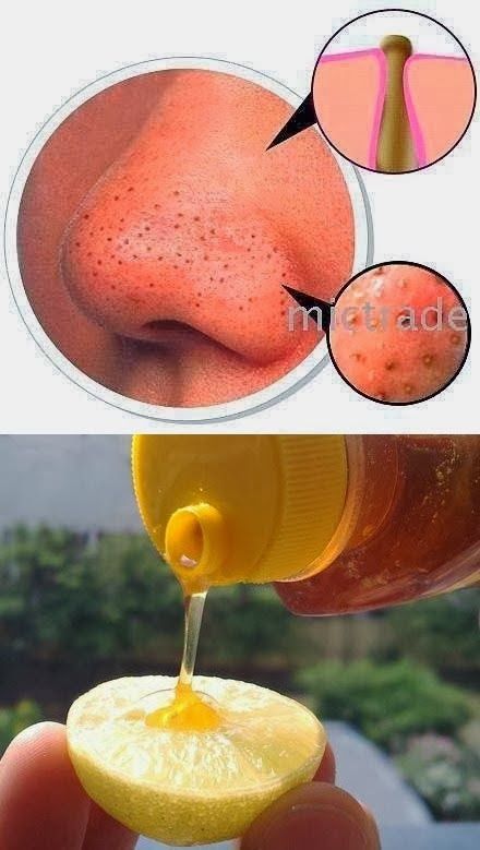 Home Remedies to Get Rid of Blackheads