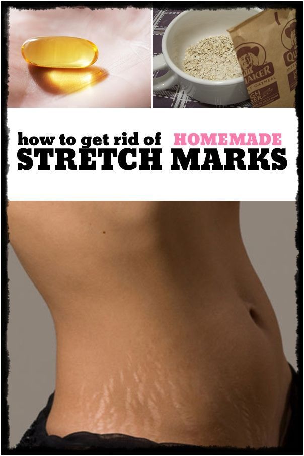 How to get rid of stretch marks – homemade