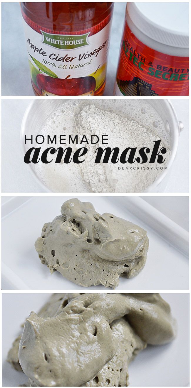 Homemade Acne Mask – This DIY acne mask has just two ingredients and will detoxify your skin while unclogging and shrinking pores.