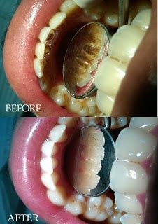 How to Get Rid of Yellow Teeth