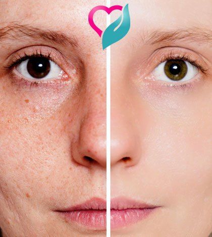 Get Rid of the Pores on Your Face, Naturally – Ethnic Health Court