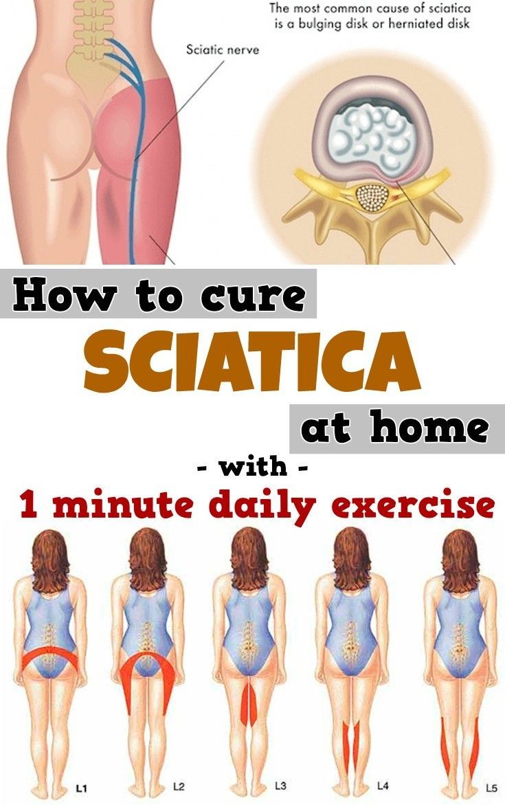 How to cure SCIATICA at home with 1 minute daily exercise (VIDEO tutorial)