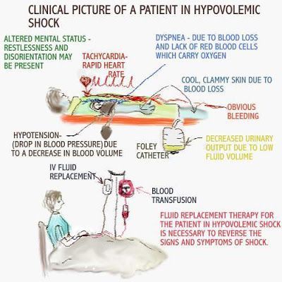 Hypovolemic Shock how are the hemodynamics effected & why? Critical care nursing