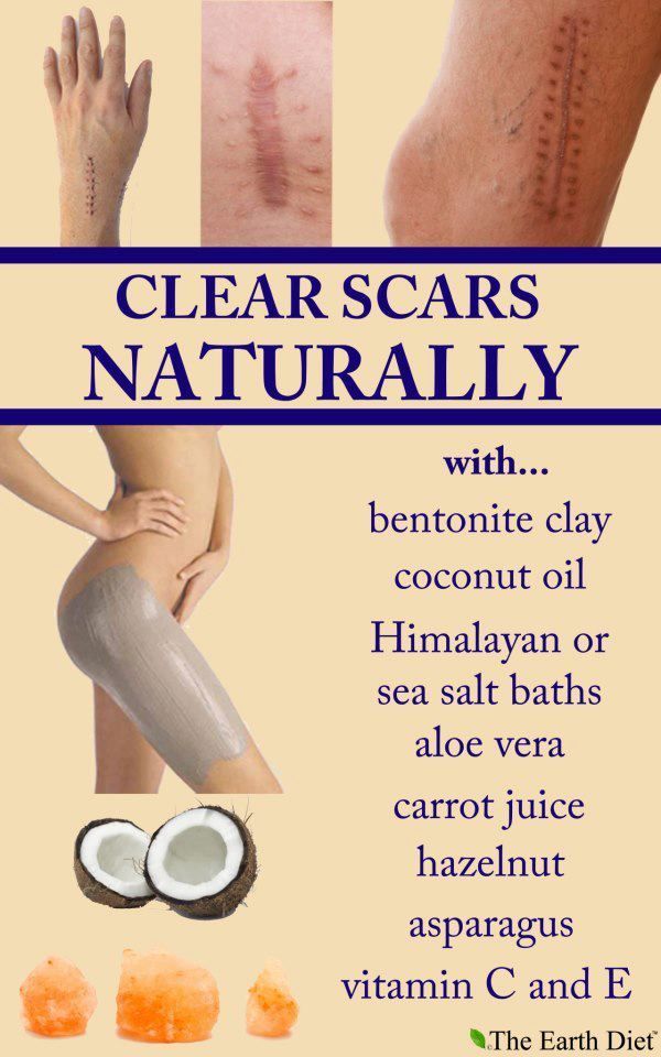 looking to heal old scars (not everyone wants or needs to), a mixture of any of these natural ingredients or even using them alone