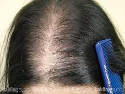 Hair Loss Treatment Using Essential Oils. If you suffer from hair loss or progressive thinning hair, you c