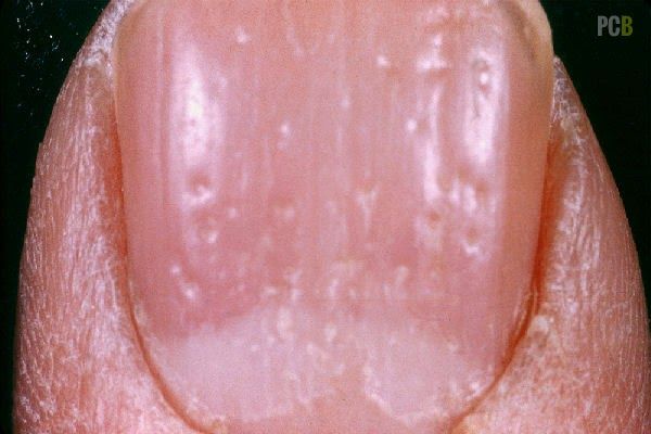 Spoon Shaped Nails -   Life-saving warnings your nails are sending