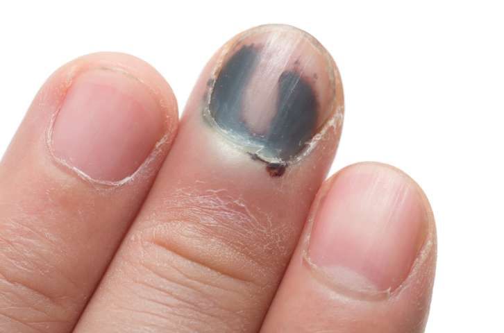 Dark Red or Brown Under Nails -   Life-saving warnings your nails are sending