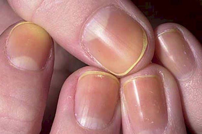 Discolored Nails -   Life-saving warnings your nails are sending