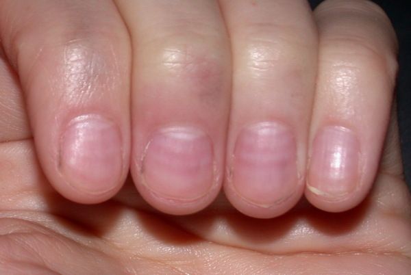 Horizontal Grooves or Ridges in Nails -   Life-saving warnings your nails are sending