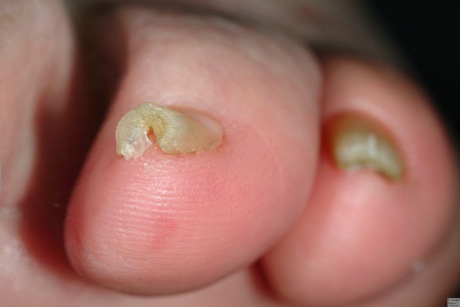 Discolored Nails -   Life-saving warnings your nails are sending
