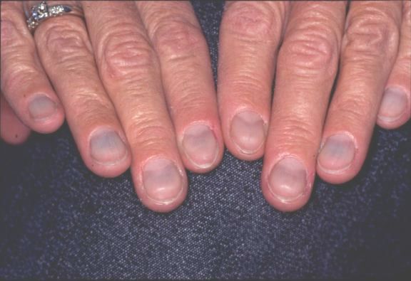 Grey Nails -   Life-saving warnings your nails are sending