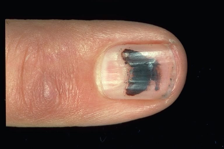 Dark Discolorations -   Life-saving warnings your nails are sending