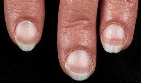 Dark Discolorations -   Life-saving warnings your nails are sending