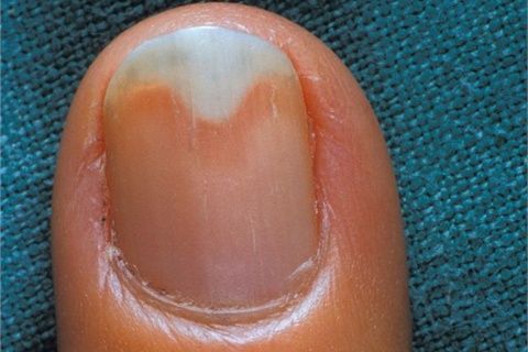 Ingrown Toenail -   Life-saving warnings your nails are sending