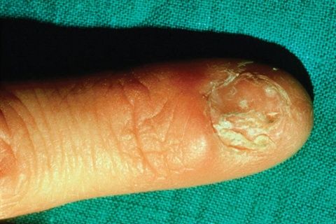 Large Ridge or Crack in the Center of the Nail -   Life-saving warnings your nails are sending