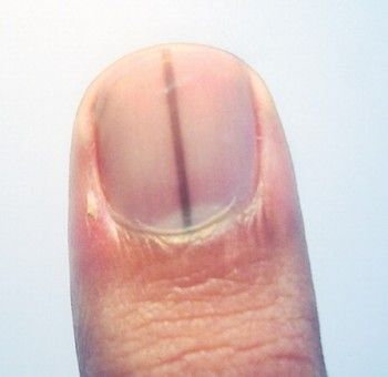 Life-saving warnings your nails are sending