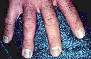 Gold Therapy Induced Brown Nails -   Life-saving warnings your nails are sending