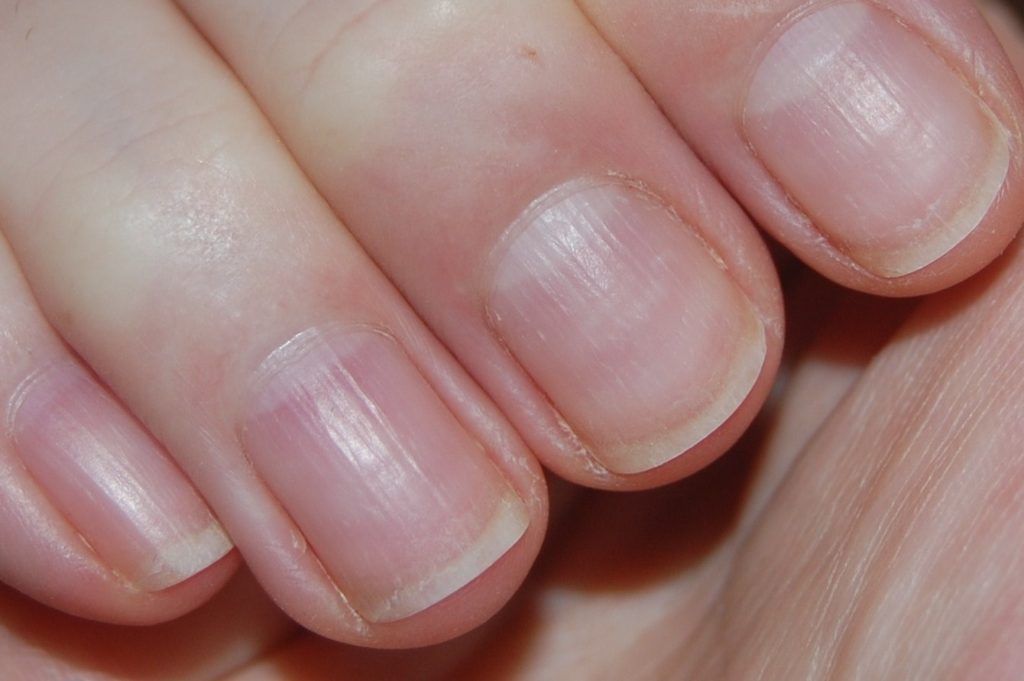 Small White Marks On Nails -   Life-saving warnings your nails are sending
