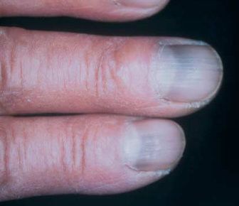 Blue or Brown Nail Discoloration -   Life-saving warnings your nails are sending