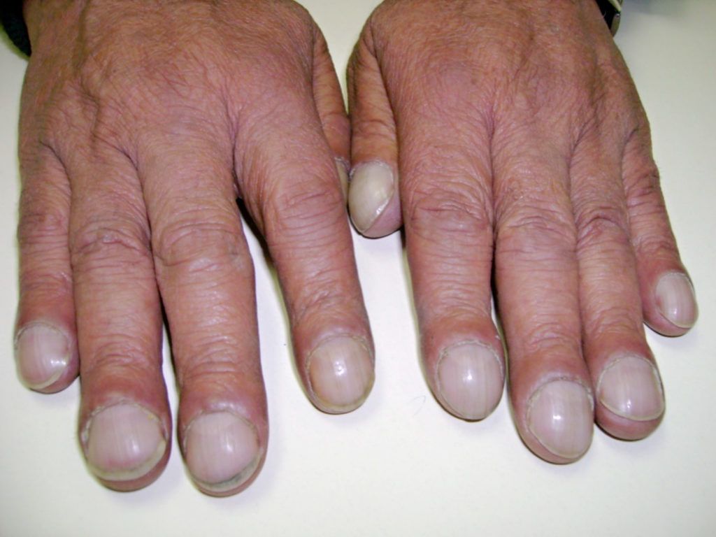Dark Stripes -   Life-saving warnings your nails are sending