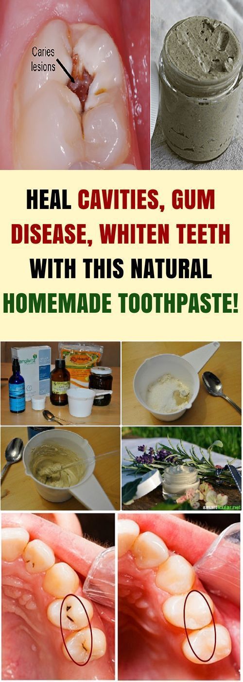 Heal Cavities, Gum Disease, & Whiten Teeth & This Natural Homemade Toothpaste!!! -   22 homemade fitness journal
 ideas