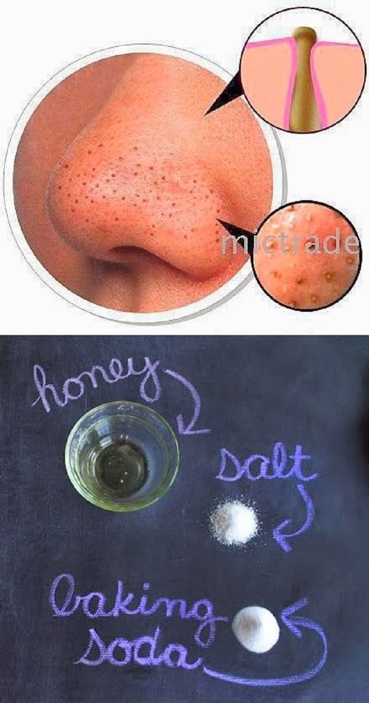 How to Get Rid of Dark Underarms -   24 diy face black heads
 ideas