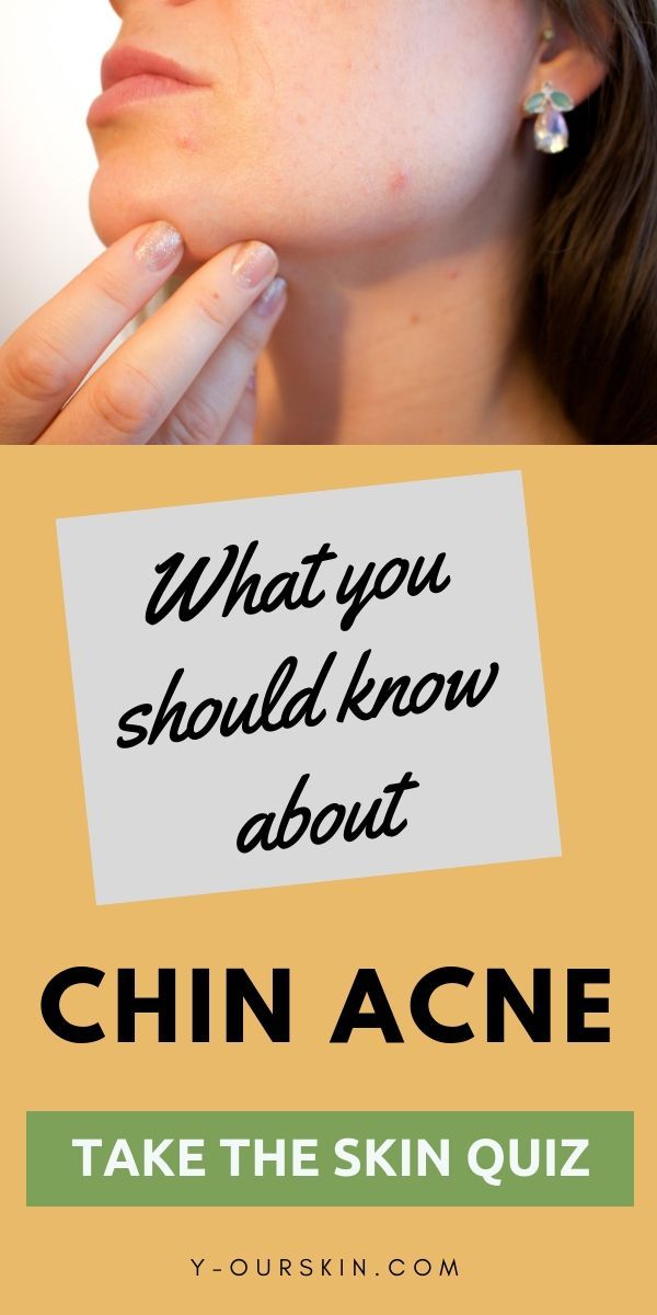 What you need to know about chin acne - Take our skin quiz to find the best regimen for hormonal acne. -   9 makeup Goals simple
 ideas