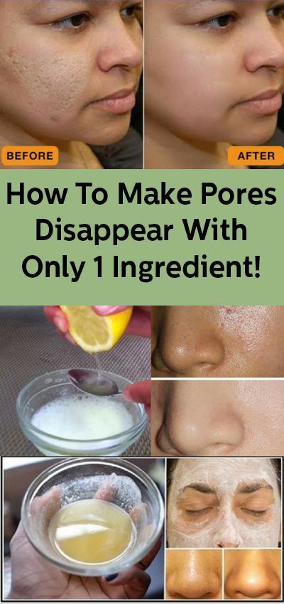 How To Make Pores Disappear With Only 1 Ingredient -   Health