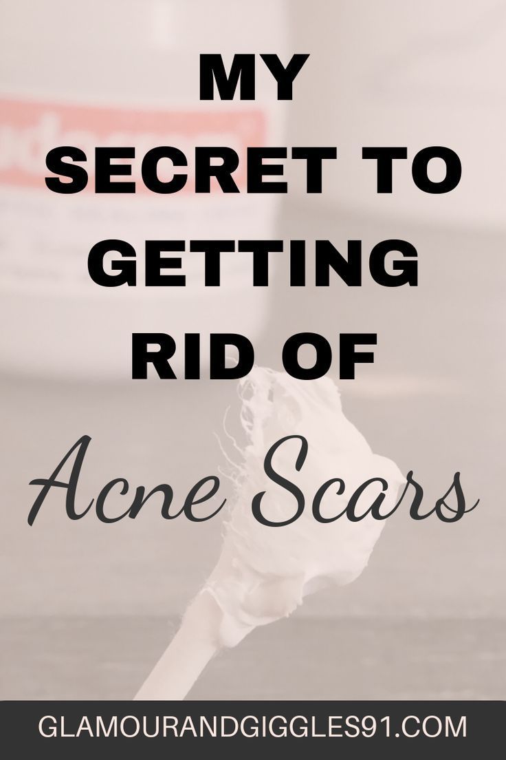 Sudocrem - My Secret To Getting Rid Of Acne Scars FAST -   9 skin care Acne how to get rid ideas