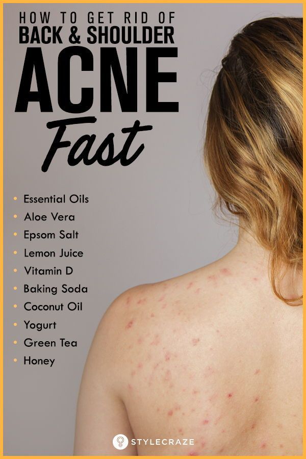 9 skin care Acne how to get rid ideas