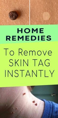 TOP 10 HOME REMEDIES TO REMOVE SKIN TAGS NATURALLY -   8 skin care Remedies life ideas