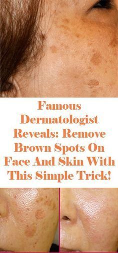 Famous Dermatologist Revealed: Remove Brown Spots On Face And Skin With This Simple Trick -   9 skin care Dry tips ideas