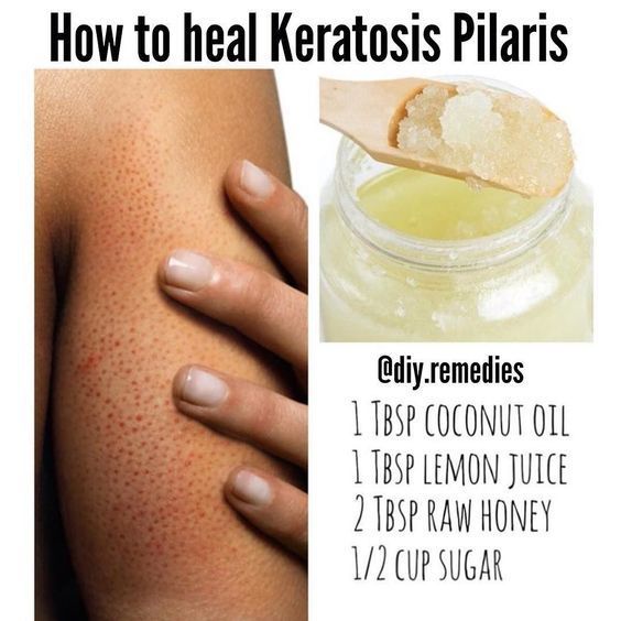How To Get Rid Of Arm Bumps a.k.a keratosis pilaris or Chicken Skin -   12 skin care Redness coconut oil ideas