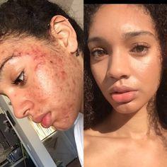 This Woman's All-Natural Acne Skin-Care Routine Is Going Viral on Instagram -   11 skin care Routine for acne ideas