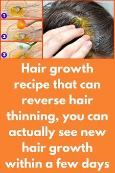 Hair growth recipe that can reverse hair thinning, you can actually see new hair growth within a few days -   12 hair Growth for men ideas