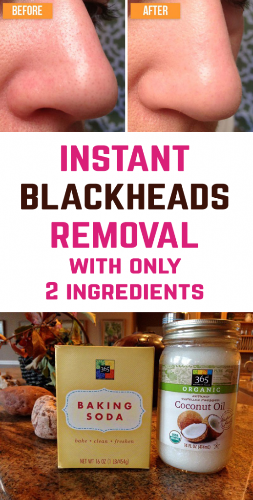 Say Goodbye to Blackheads on Your Face With Only 2 Ingredients -   13 skin care Homemade remedies ideas