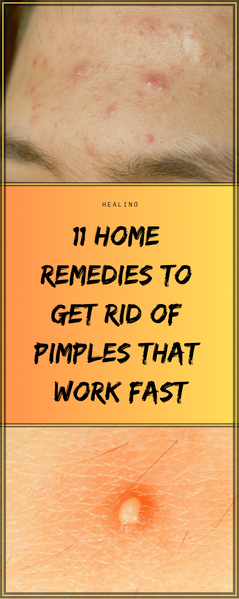11 Home Remedies To Get Rid Of Pimples That Work Fast -   18 makeup Beauty remedies ideas
