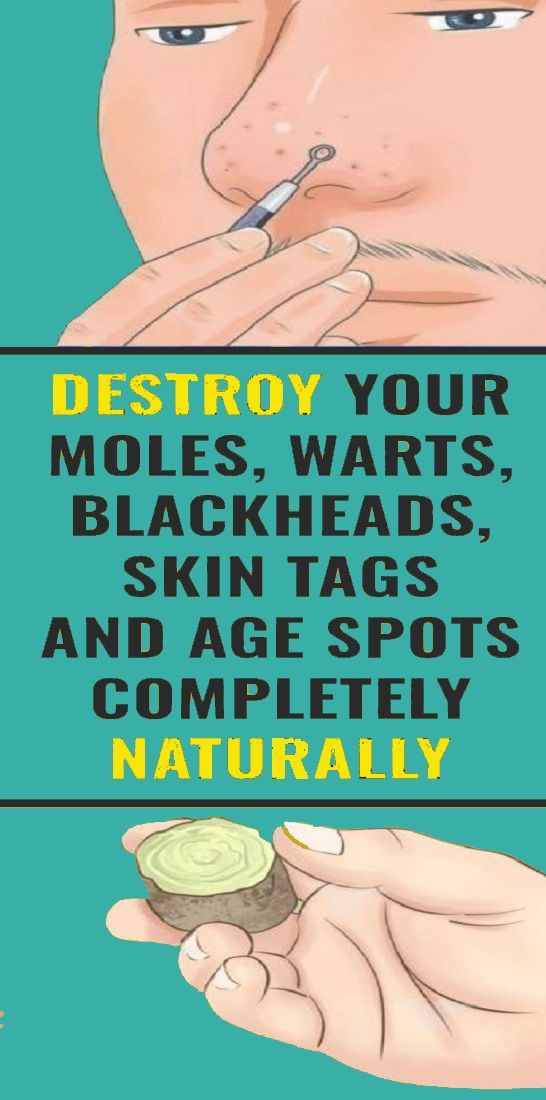 Destroy Your Moles, Warts, Skin Tags and Age Spots Naturally -   18 makeup Beauty remedies ideas