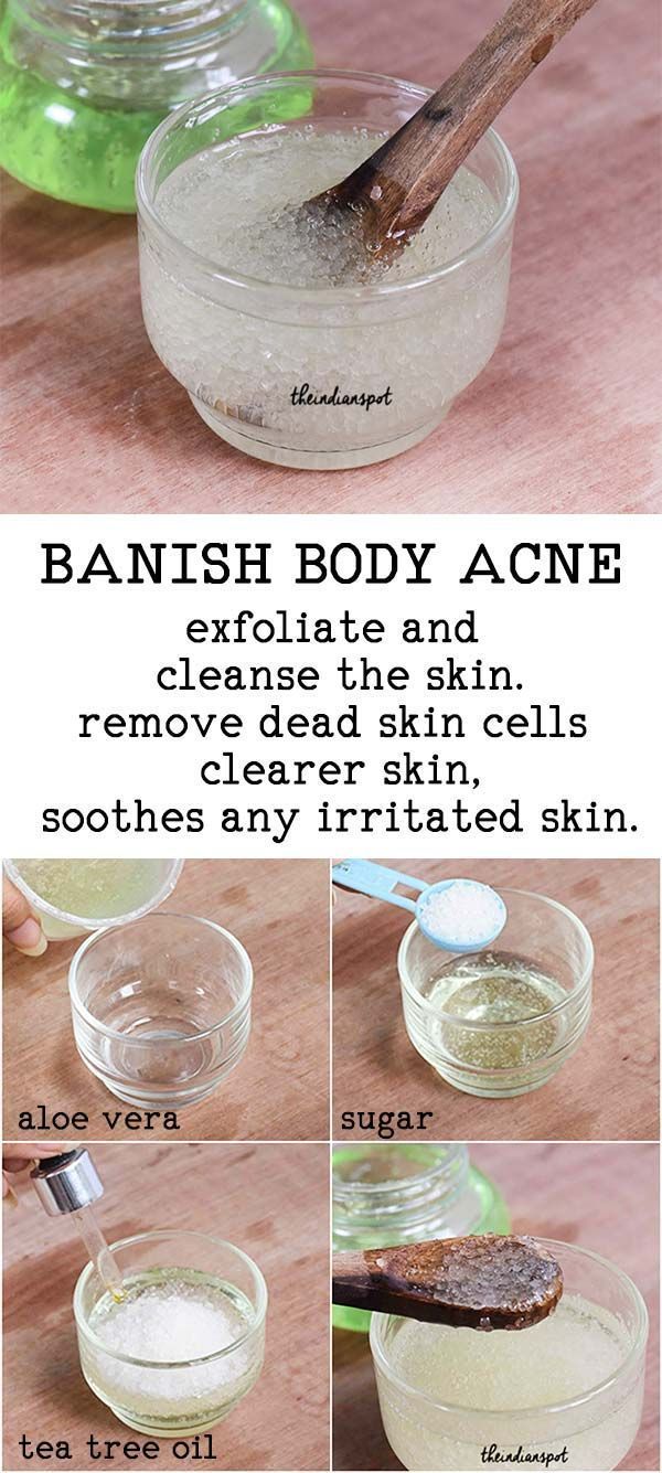 Tired Of Embarrassing Back Acne? Could You Use These Back Acne Treatment Tips? | Natural Skin Care -   9 skin care Body treats ideas