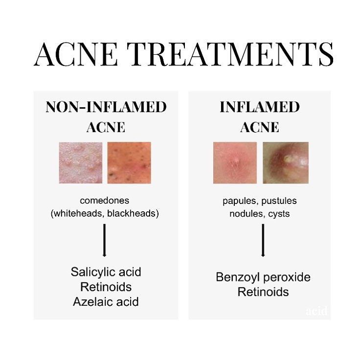 acid on Instagram: “IMPORTANT: Not all acne is the same, this is very important because the type (or types) of acne a patient has will influence their…” -   8 skin care Regimen life ideas
