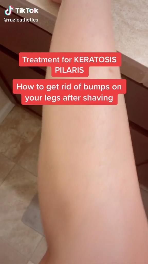 17 how to get rid of strawberry legs fast ideas