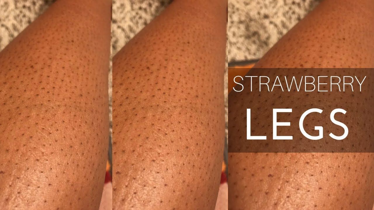 How to Get Rid of Strawberry Legs - Healthrave -   17 how to get rid of strawberry legs fast ideas